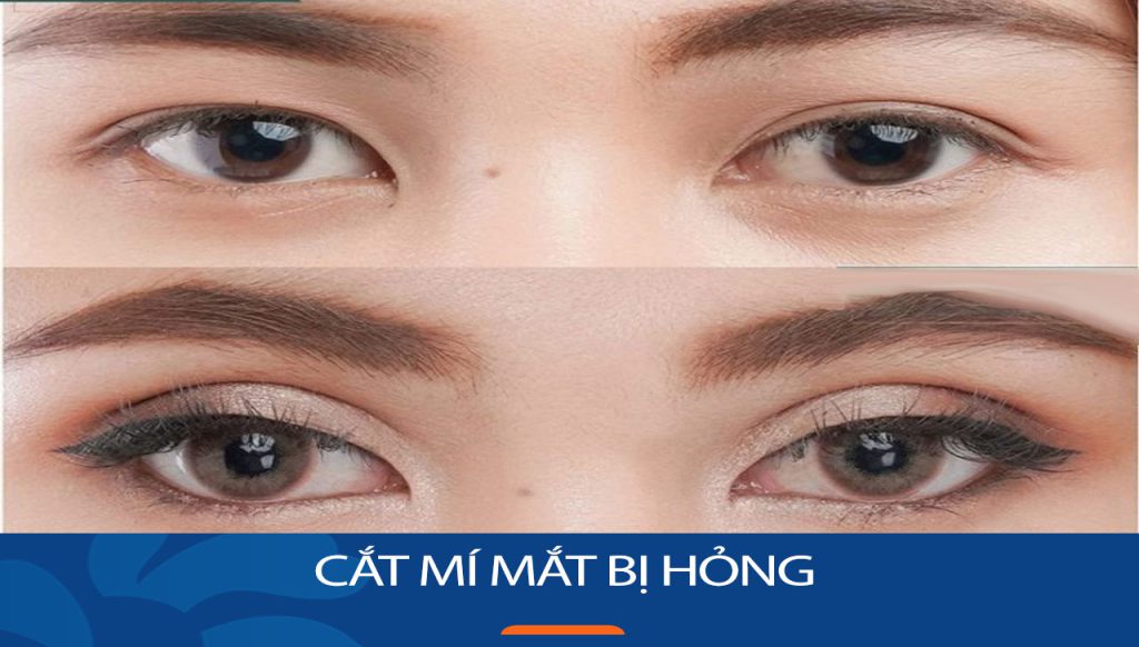 Cắt mí hỏng là gì? Dấu hiệu nhận biết, nguyên nhân và hướng xử lý