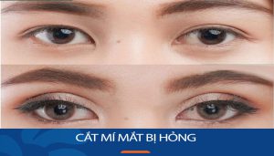 Nhận biết và khắc phục các biểu hiện khi cắt mí mắt bị hỏng