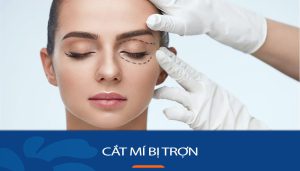 Cắt mí bị trợn có sửa được không? Phương pháp khắc phục và phòng tránh