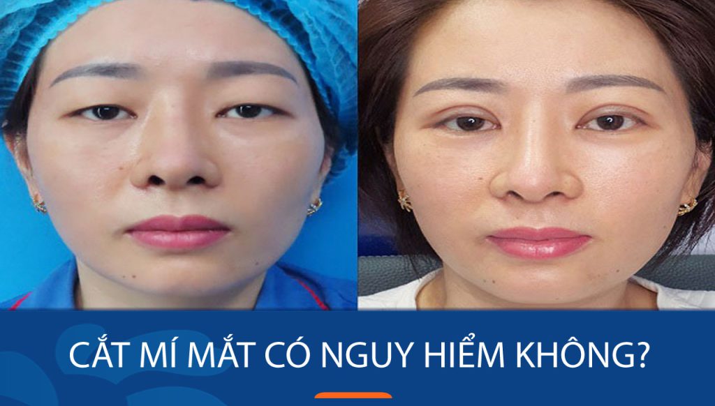 Cắt mí mắt có nguy hiểm không? Giải đáp mọi thắc mắc!