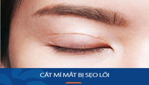 Cắt mí mắt có bị sẹo lồi không? Giải đáp từ chuyên gia