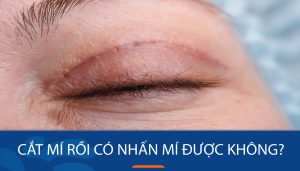 Cắt mí rồi có nhấn mí được không - sự lựa chọn phù hợp cho bạn