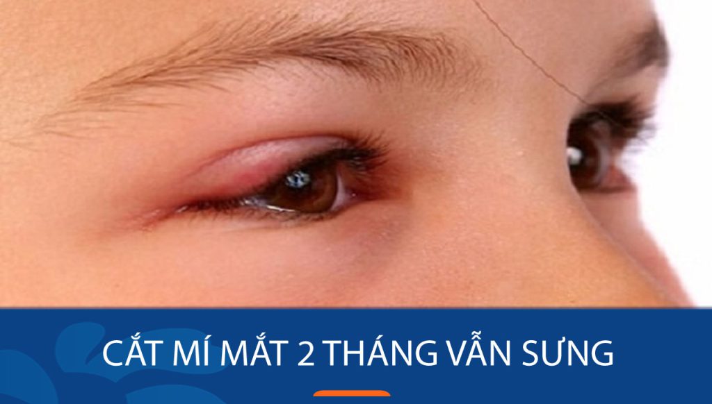 Cắt mí mắt 2 tháng vẫn sưng: Nguyên nhân, dấu hiệu bất thường và cách xử lý