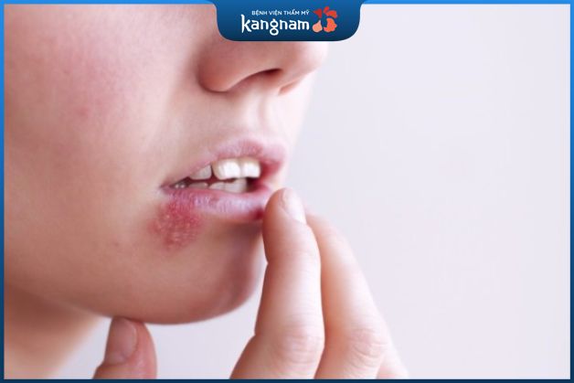 Cẩn thận khi chăm sóc và điều trị mụn môi tại nhà