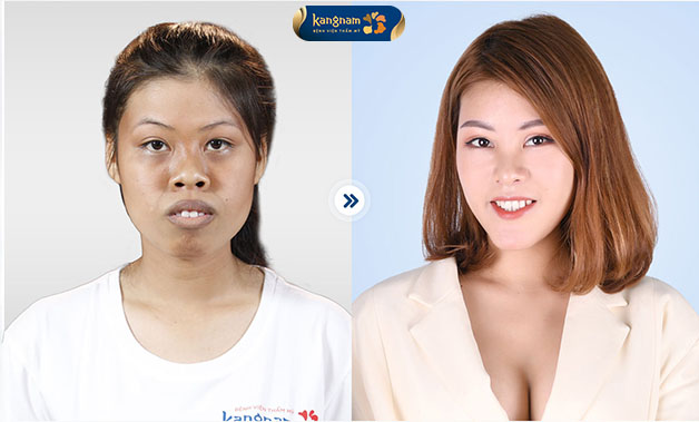 Hết hô, hết tự ti, sở hữu diện mạo xinh xắn và nụ cười rạng rỡ