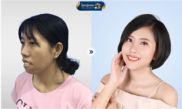 Khách hàng trẻ ra đến 10 tuổi sau khi chỉnh hàm hô