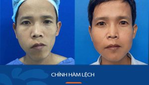 Chỉnh hàm lệch: Nguyên nhân, dấu hiệu và các phương pháp điều trị hiệu quả