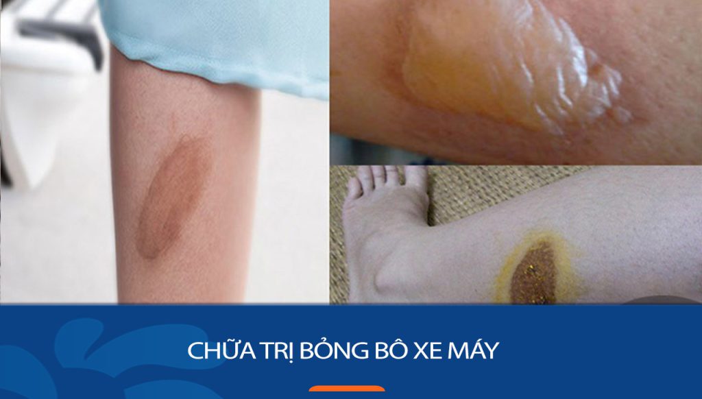 Cách chữa bỏng bô xe máy hiệu quả không để lại sẹo