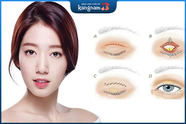 Có nên cắt mắt 2 mí không?