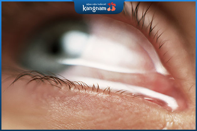 Trong quá trình phẫu thuật tác động đến tuyến lệ sẽ làm chảy nước mắt