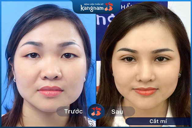 hình ảnh sau phẫu thuật cắt mắt 2 mí tại Bệnh viện thẩm mỹ Kangnam