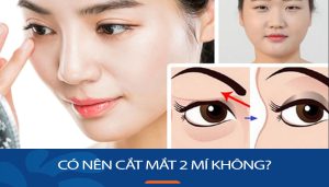Có nên cắt mắt 2 mí không? Khi nào nên và không nên thực hiện