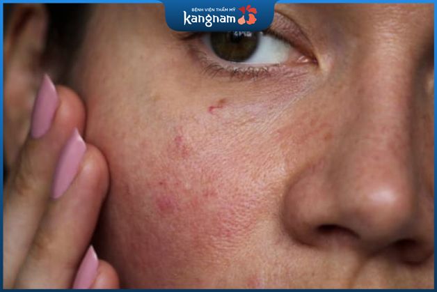 Da nhạy cảm và nổi mẩn