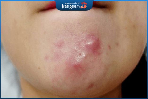 Khi chạm vào, mụn chai thường có cảm giác khô sần như một vết chai