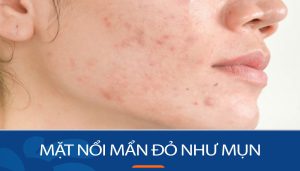 Mặt nổi mẩn đỏ như mụn: Bí quyết đánh bay mẩn đỏ như mụn trên mặt