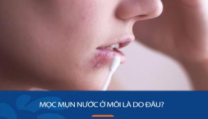 Mụn nước ở môi do herpes: Lây lan và phòng ngừa