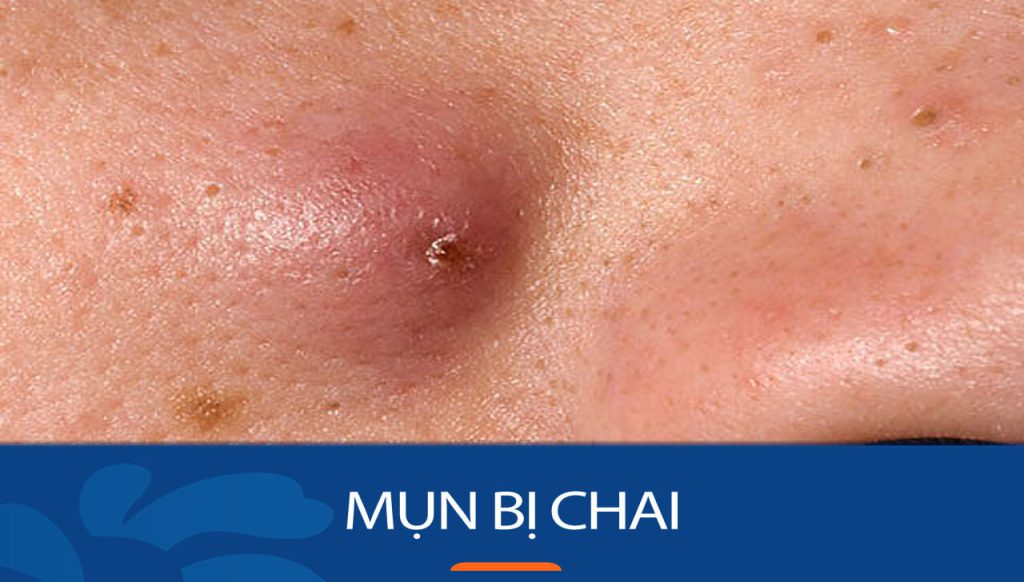 Nên làm gì khi bị mụn chai? Giải pháp toàn diện cho làn da mịn màng