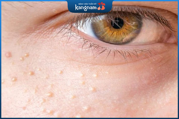 Mụn thịt có thể xuất hiện trên da của bất cứ ai