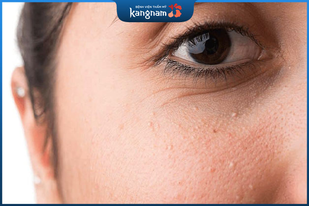 Những nốt mụn có thể to hoặc nhỏ tùy vào tình trạng