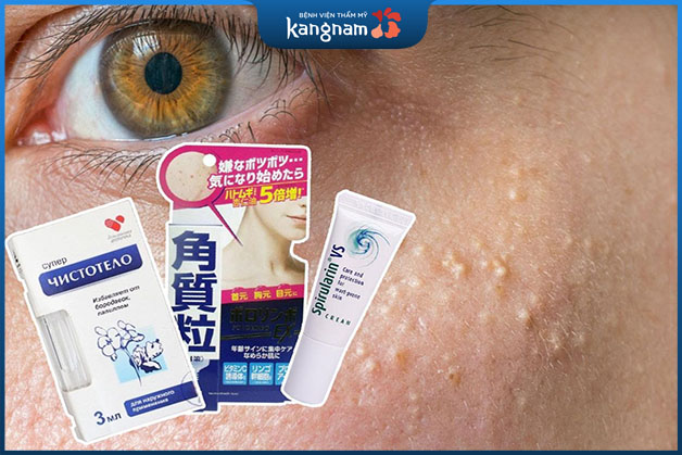 Trên thị trường có nhiều loại thuốc trị mụn đá