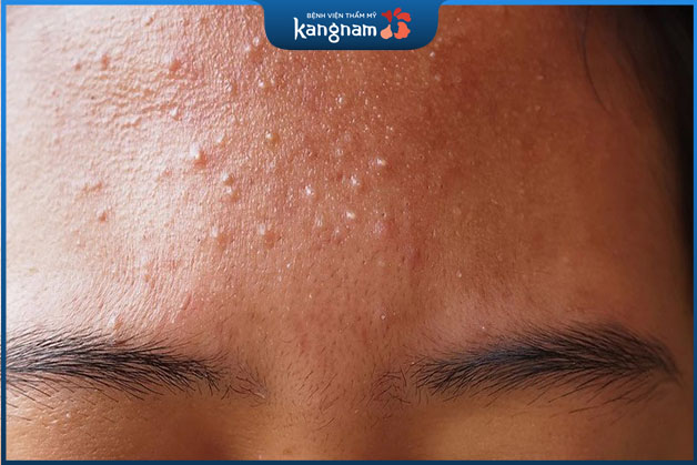 Những nốt mụn thường xuất hiện thành cụm tại một vị trí 