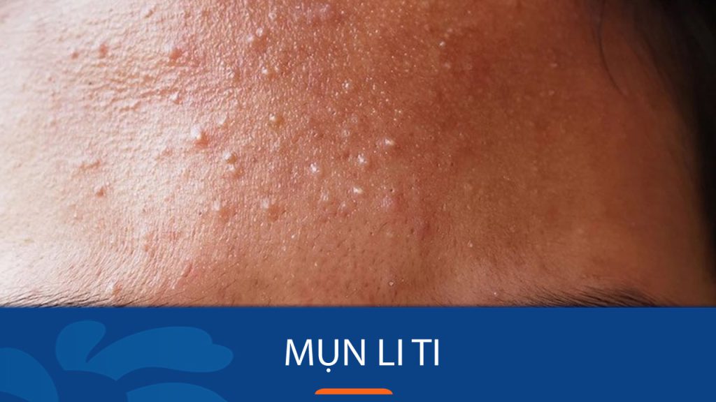 Bí quyết loại bỏ mụn li ti vĩnh viễn, da mịn màng không tì vết.