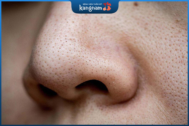 Nốt đầu đen thường dễ nhận biết nhất