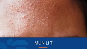 Bí quyết loại bỏ mụn li ti vĩnh viễn, da mịn màng không tì vết.