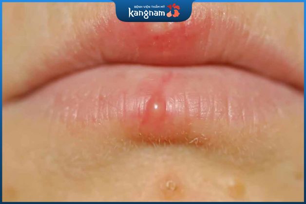 Mọc mụn nước ở môi là do đâu
