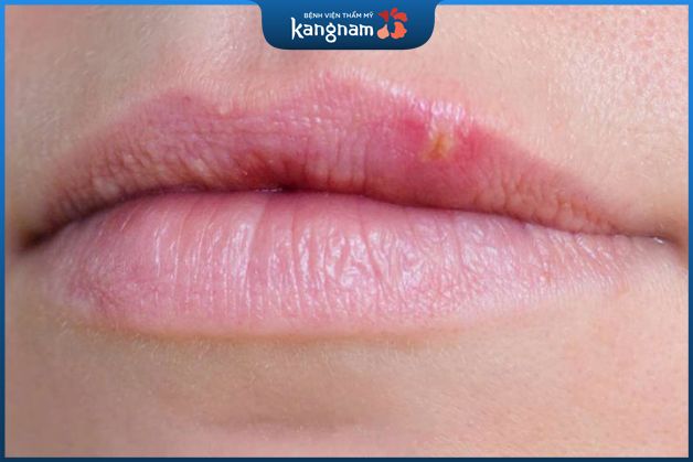 Mụn nước ở môi có thể do kinh nguyệt