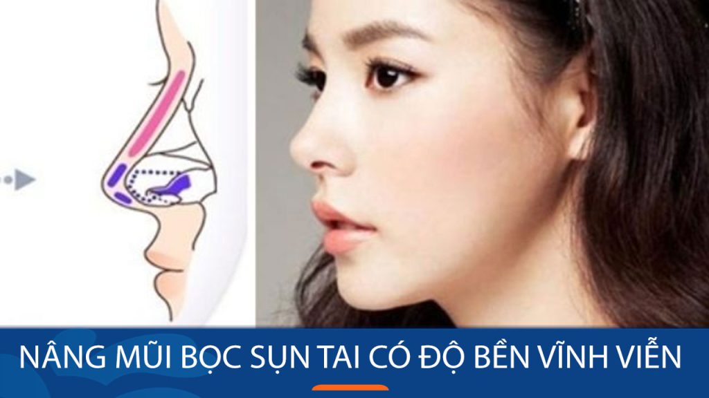 Nâng mũi bọc sụn tai có vĩnh viễn không? Thời gian duy trì & yếu tố ảnh hưởng