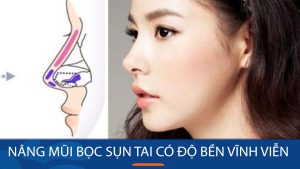 Nâng mũi bọc sụn tai có vĩnh viễn không? Thời gian duy trì & yếu tố ảnh hưởng