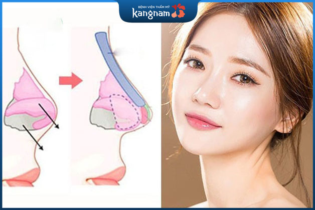 Mũi sau khi nâng đẹp như mũi tự nhiên