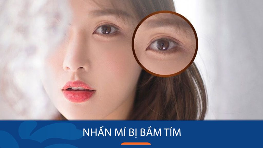 Nhấn mí bị bầm tím: 4 Cách khắc phục nhanh