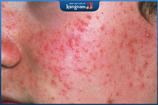 Mụn li ti và mẩn đỏ hình thành có thể đến từ nguyên nhân