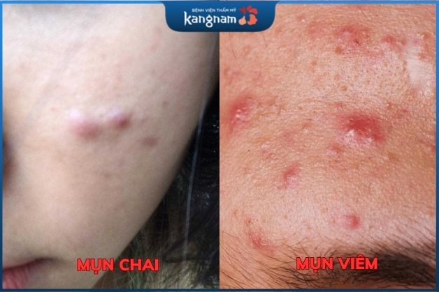Mụn viêm nang thường có màu trắng hoặc vàng, có mủ và đau nhức.