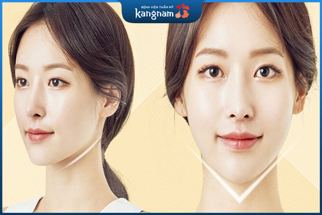 Filler sẽ tan sau khi tiêm từ 6 - 18 tháng 