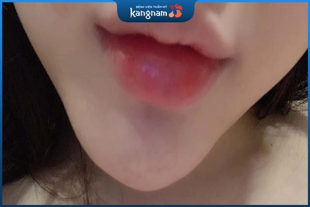 Dùng filler chất lượng kém thậm chí còn gây ra biến chứng khó lường 