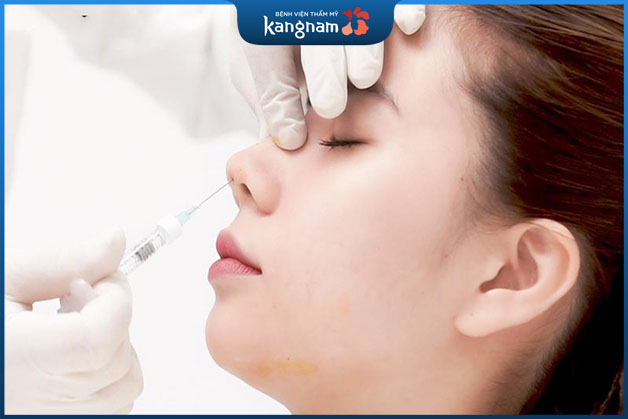 Filler là chất làm đầy được tiêm vào để cao sống mũi