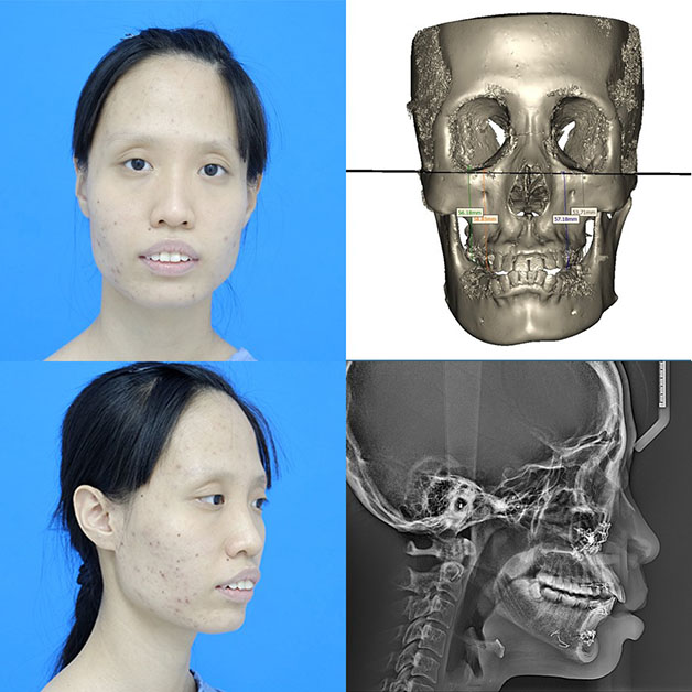 Phương pháp chỉnh hàm hô