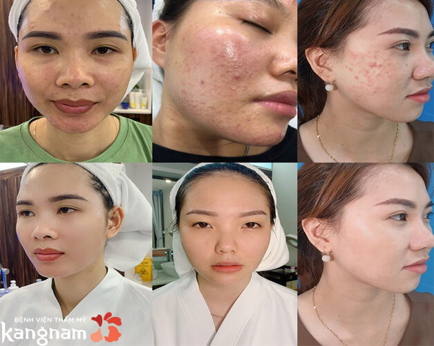 Trị mụn tại Kangnam khỏi dứt điểm sau 1 liệu trình
