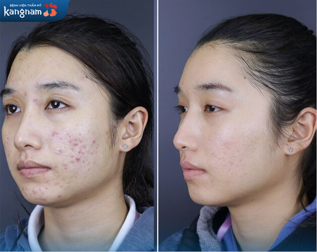 Sẹo thâm do mụn cũng được giải quyết nhanh gọn