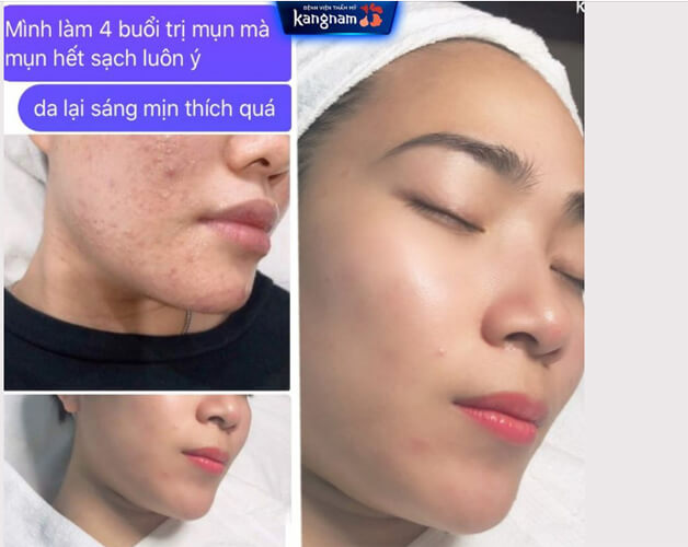 Khách hàng feedback trị mụn tại Kangnam