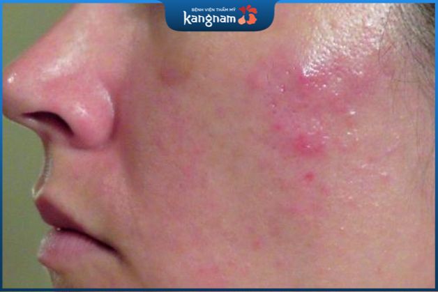 Viêm da tiết bã thường được gây ra bởi một loại nấm gọi là Malassezia