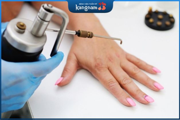 Liệu pháp đóng băng (đông lạnh) chữa mụn hạt cơm