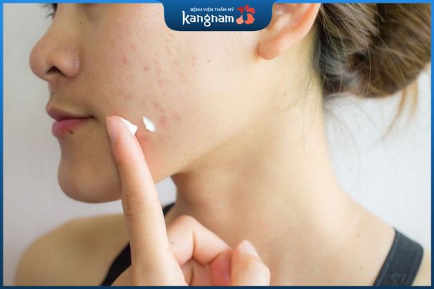 Bôi thuốc trị mụn viêm trên má