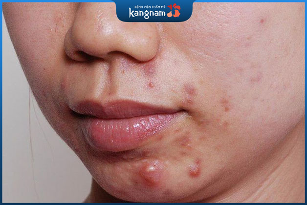 Mụn viêm nặng hoặc những ổ mụn lớn thì không được tự ý nặn