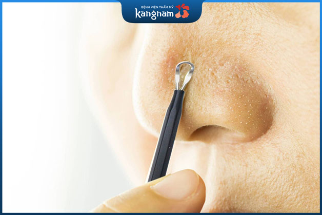 Trước khi lấy nhân mụn cần phải khử khuẩn que nặn mụn