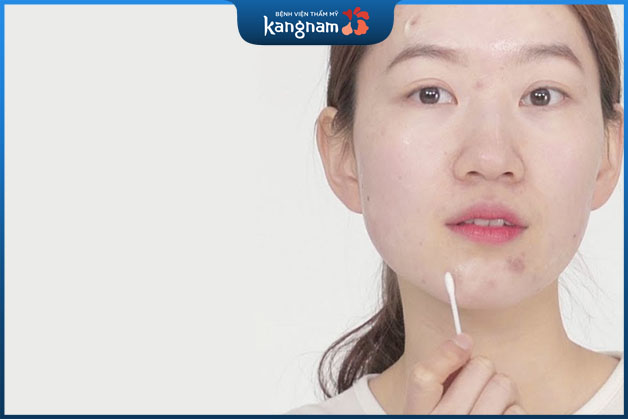 Dùng tăm bông ấn nhẹ nhàng để nhân mụn trồi lên