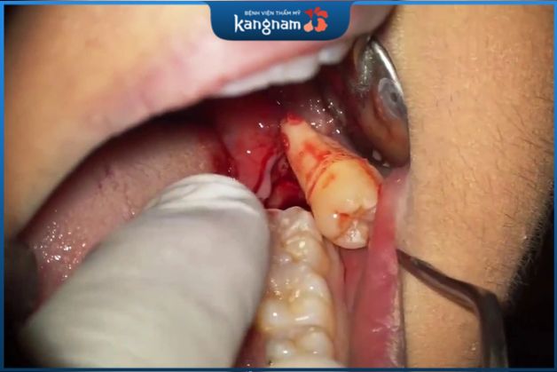 Chảy máu là một phản ứng phổ biến sau khi nhổ răng khôn